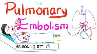 Pulmonary Embolism PE [upl. by Mattox]