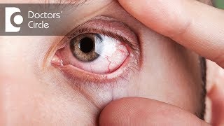 What causes visible red fine lines in eyes  Dr Elankumaran P [upl. by Buchanan634]