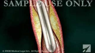 Balloon Angioplasty  ANC00203 [upl. by Aeuhsoj906]