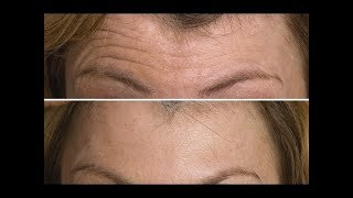 Face Exercise to Lift amp Tighten Your Forehead  FACEROBICS® [upl. by Agneta]