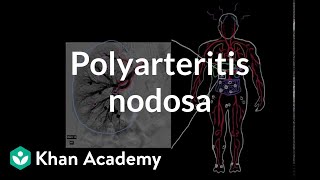 Polyarteritis nodosa  Circulatory System and Disease  NCLEXRN  Khan Academy [upl. by Eidderf454]