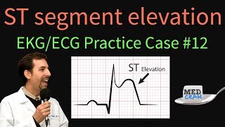 ST Elevation  EKG  ECG Interpretation Case 12 STEMI MI ACS [upl. by Rahal]