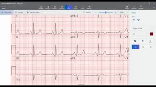 Insuficiencia Cardíaca Congestiva Diagnóstico y Lectura ECG [upl. by Ordnazil]