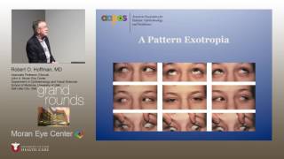 Pattern Strabismus [upl. by Gatias]