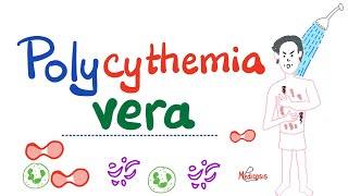 Polycythemia Vera PV  Myeloproliferative Neoplasm MPN  Erythrocytosis  Hematology [upl. by Channing491]