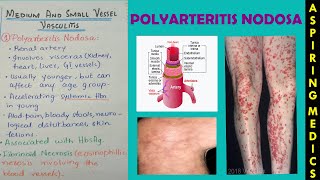 Polyarteritis nodosa pathology lectureVasculitis part 2 ASPIRING MEDICS [upl. by Arocal730]