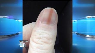 Melanoma on Your Nail [upl. by Pages]