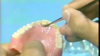 Replacing a Broken Complete Denture Tooth [upl. by Eliath]