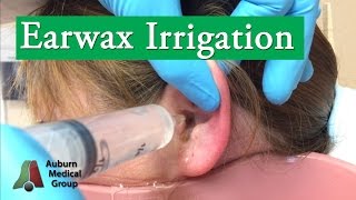 Ear Wax Irrigation  Auburn Medical Group [upl. by Yrod178]