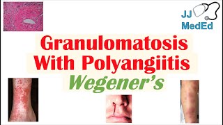 Granulomatosis with Polyangiitis Wegener’s granulomatosis  Symptoms Diagnosis Treatment [upl. by Gnoh334]