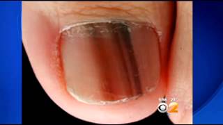 Doctors Warn Of Potentiall Deadly Form Of Nail Cancer [upl. by Raddie]