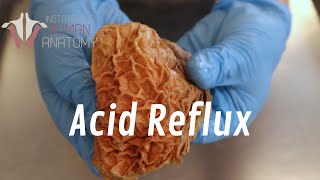 What Is Acid Reflux [upl. by Ronna]