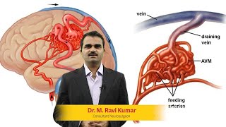 What happens after surgery for an arteriovenous malformation [upl. by Ogdan]