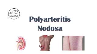 Polyarteritis Nodosa PAN  Signs amp Symptoms Diagnosis Treatment [upl. by Ellegna819]