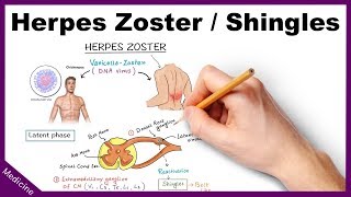 Herpes ZosterShingles Symptoms Diagnosis Treatment [upl. by Rider]