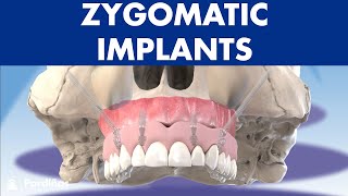 Temporal Approach to elevate and reduce zygomatic arch fracture  maxillofacial surgery  Richardson [upl. by Ellita]