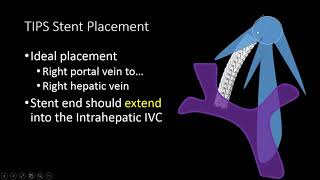 TIPS Stent US Doppler Evaluation [upl. by Asiluj926]