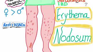 Erythema Nodosum [upl. by Ramat]