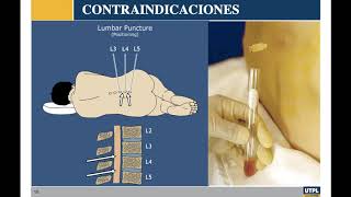 Punción Lumbar Líquido cefalorraquídeo Peritoneo Meninges de la Médula espinal y Cerebro [upl. by Rosy]