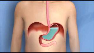 What to do about Acid Reflex GERD GastroEsophageal Reflux [upl. by Marsland]