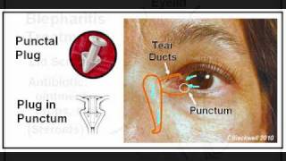 Dry Eye 2 Diagnosis and Treatment [upl. by Celene517]