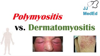 Idiopathic Inflammatory Myopathies  Polymyositis vs Dermatomyositis [upl. by Yalahs]