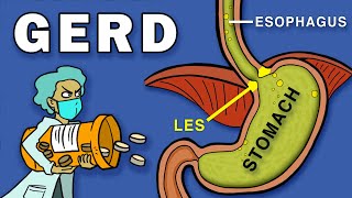 Gastroesophageal Reflux Disease GERD [upl. by Kcirdaed]