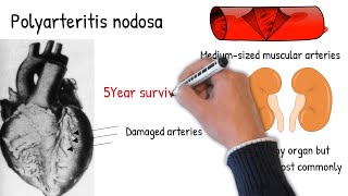 Polyarteritis nodosa made easy [upl. by Retsam]