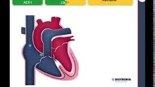 Insuficiencia Cardiaca  Manejo [upl. by Halstead]