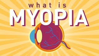 What is Myopia Short sightedness [upl. by Ineslta233]