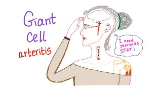 Giant cell arteritis Temporal arteritis [upl. by Neiluj83]