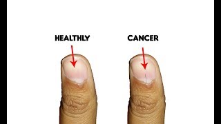 9 Fingernails serious alarming health issues and probllems [upl. by Edmee843]