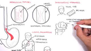 GORD GERD Gastro Oesophageal Reflux Disease  Overview pathophysiology treatment [upl. by Atinwahs]