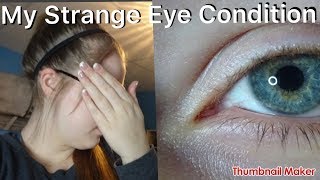 My Strange Eye Condition  Myopia  Astigmatism [upl. by Ragnar335]