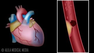 Myocardial Infarction and Coronary Angioplasty Treatment Animation [upl. by Annadal780]