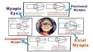 Myopia  Introduction and Etiology within 3 min 15 [upl. by Pavyer]