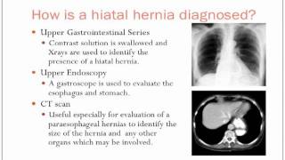 Hiatal Hernias [upl. by Shuma]