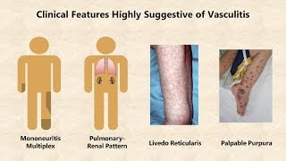 Vasculitis  An Overview [upl. by Marba]