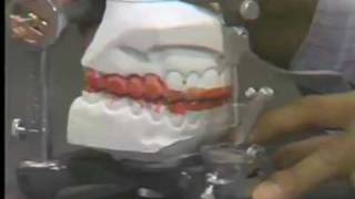 Occlusal Adjustment  Centric Relation [upl. by Maighdiln918]