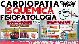 CARDIOPATÍA ISQUÉMICA FISIOPATOLOGÍA  GuiaMed [upl. by Irakab]