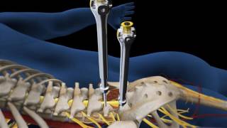 Lumbar Fusion of L5 S1 Animation [upl. by Anahsar758]