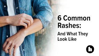 6 Common Rashes And What They Look Like  Healthline [upl. by Eugeniusz]