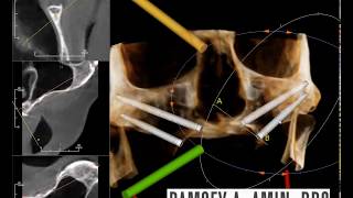 Zygomatic Immediate Load Dental Implant Planning [upl. by Lydnek]